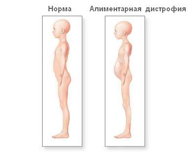 alimentarnyj-marazm-alimentarnaya-distrofiya.jpg