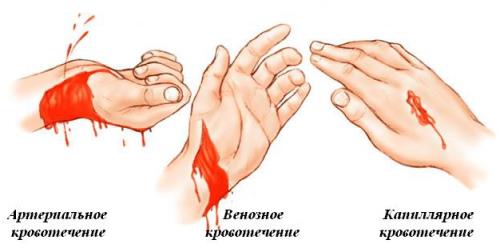 krovotechenie-1.jpg