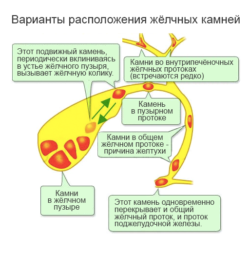 cholelithiasis_variants.png
