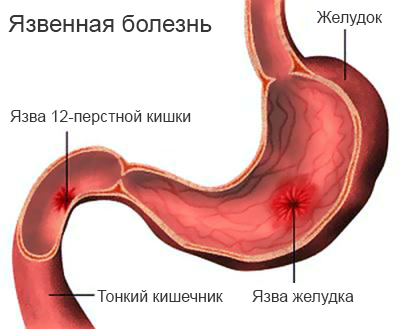 60554-udalenie-12-perstnoy-kishki-posledstviya.png
