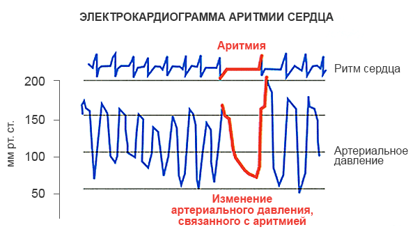 аритмия.png