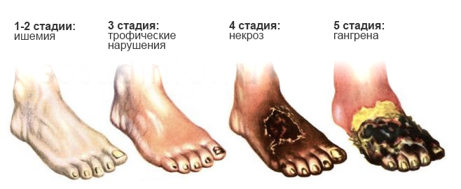 сердечно-сосудистые-заболевания.png