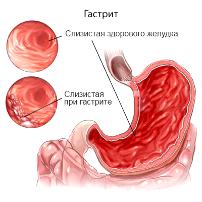 1gastritis.png