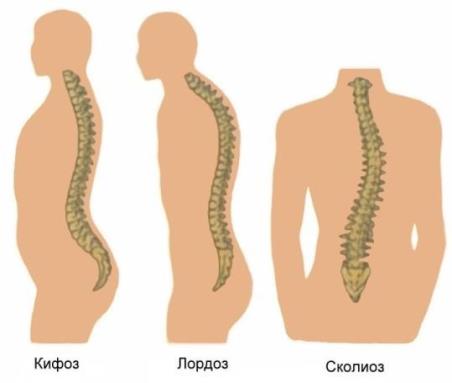 Деформация-позвоночника.jpg