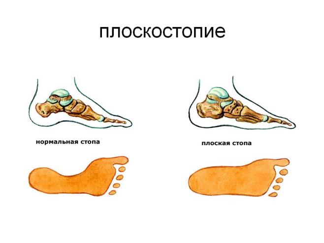 0015_015_ploskostopie.jpg